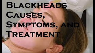 Blackheads Causes Symptoms and Treatment [upl. by Vial]