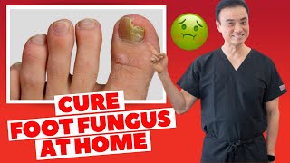 6 Effective HOME REMEDIES To CURE Toenail FUNGUS  Holistic Toenail Fungus Cures Part 2  Dr Kim [upl. by Okramed]