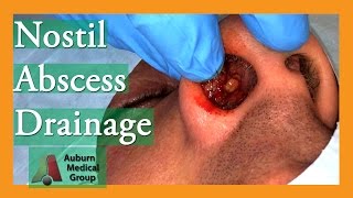 Nostril Abscess Drainage  Auburn Medical Group [upl. by Lot204]