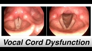 vocal cord dysfunction  Patient Education Video [upl. by Yennep909]