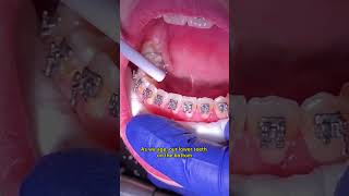 What is a permanent retainer in braces Toothtime New Braunfels Dentist  Braces journey [upl. by Ahsinna673]