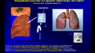 HCPA  Grand Round  TPET Uma perspectiva para o Tratamento de Enfisema Pulmonar Avançado [upl. by Nho463]