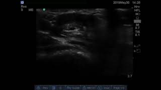 ULTRASOUND GUIDED AXILLARY BRACHIAL PLEXUS BLOCK 2 GOOD [upl. by Beera]