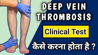 Deep vein thrombosis Clinical Examination  Homans Test for DVT [upl. by Oswell]