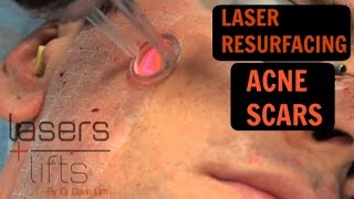 HOW TO TREAT ACNE SCARS  Laser resurfacing and TCA CROSS [upl. by Yekciv]