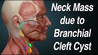 Neck Mass Due to Branchial Cleft Cyst [upl. by Ak]