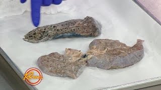 Here’s the Reality of How Smoking Affects Your Lungs… and It’s Not Pretty [upl. by Annohsak936]