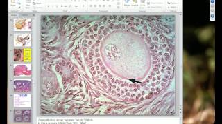 Medical School Pathology 2012 Session 063 Female Genital Tract IImp4 [upl. by Linker]