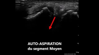 Première visualisation en échographie dune centralisation dun ménisque médial subluxé [upl. by Onfroi]