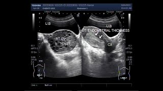 Endometrial Hyperplasia and Hemorrhagic Ovarian Cyst [upl. by Reamy]