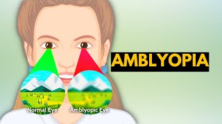 Amblyopia Causes Signs and Symptoms Diagnosis and Treatment [upl. by Retep]