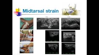 midtarsal strain flat foot [upl. by Kennet514]