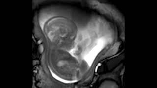 MRI scan at 21 weeks [upl. by Anirod]