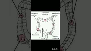 Colostomy medicaleducation viralshort shorts body nursingofficer [upl. by Yaja]