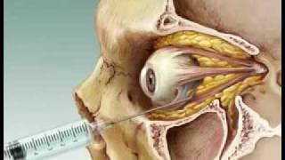 Eye Anesthesia Retrobulbar block [upl. by Orrin]