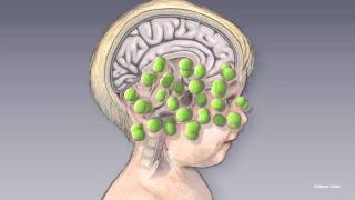 Introduction to Viral Meningitis Encephalitis and Meningoencephalitis [upl. by Ydaf]