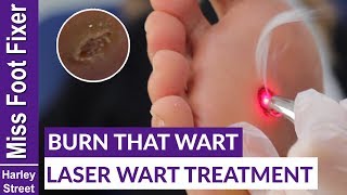 LASER TREATMENT FOR WARTS BY MISS FOOT FIXER [upl. by Schild]