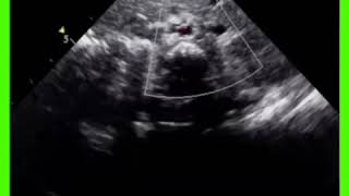 Dextrocardia Situs Inversus Echocardiography [upl. by Selig]