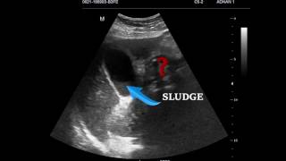 EMERGENCY ULTRASOUND IN RIGHT UPPER QUADRANT PAIN CASE 1 [upl. by Adnarb347]