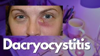 Dacryocystitis  Ophthalmology Notes [upl. by Phalan]