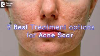 5 Best Treatment options for Acne Scar  Dr Sankeerth Vijayakumar [upl. by Ula]