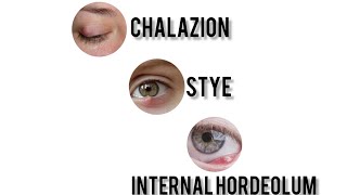 Chalazion vs External Hordeolum Stye vs Internal Hordeolum  Explained 👁️ [upl. by Aniarrol977]