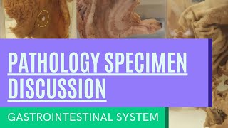 Pathology Specimen Discussion  Gastrointestinal System [upl. by Enia]