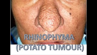 RHINOPHYMA POTATO TUMOUR [upl. by Tesler]