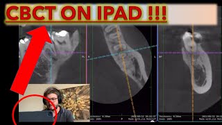 How to Open CBCT on the Ipad and Read any Radiographs and DICOM files cbct oralradiology [upl. by Siriso]