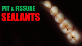 Pit and fissure sealants [upl. by Hannon]