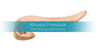 Whipple Procedure Why and How the Surgery Is Performed [upl. by Nuahsak408]