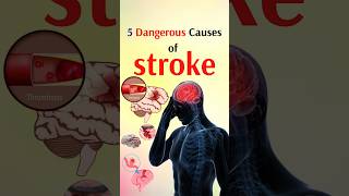 5 Dangerous Causes of stroke shorts [upl. by Eatnoed]