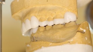 Tips and Tricks Diagnostic Dental Wax Ups [upl. by Rebmac]