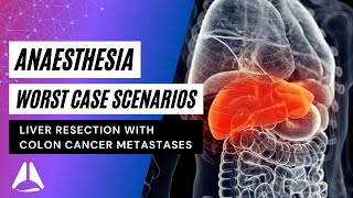 Liver Resection for Colon Cancer Mets  Worst Case Scenarios  anesthesia anaesthesia exam [upl. by Tessil]