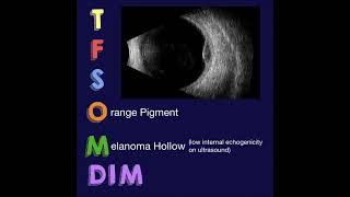 TFSOM DIM Risk Factors for Choroidal Nevus Growth to Melanoma [upl. by Naerad]