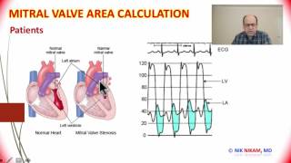 Heart Valves  Mitral Valve Area Calculation by Cath  Dr NIK NIKAM [upl. by Shena2]