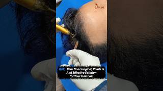 GFC Treatment for Hair Regain Your Hairs Health and Volume shortsfeed [upl. by Baoj]