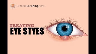 How to Treat Eye Styes [upl. by Ludovika970]