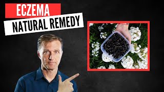 Best Natural Remedy for Eczema [upl. by Willin47]