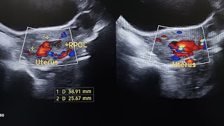 Vascular Rpoc Retained products of conception [upl. by Alle]