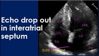 Echo drop out in interatrial septum [upl. by Truc]