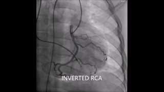 Inverted coronary arteries of corrected transposition of great arteries [upl. by Wichern124]