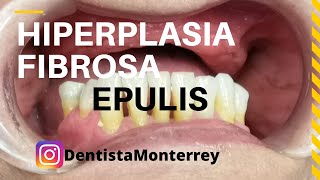 EPULIS HIPERPLASIA Fibrosa👅Causada por Prótesis Dentales [upl. by Furr426]