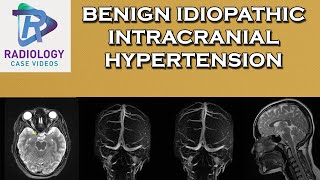 Benign idiopathic intracranial hypertension [upl. by Alica]