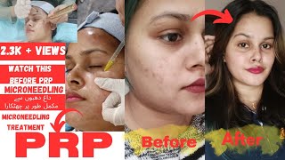 prp microneedling treatment kia hota haiPRP micro needling kese hota haifull explained in urdu [upl. by Cissiee]