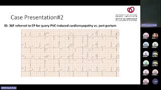 Frequent Ventricular Ectopy Defining Outcomes When and How to Treat with Michael Thibert MD [upl. by Okoyk]