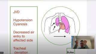 Tension Pneumothorax Pathophysiology Etiology and Treatment in the Prehospital Setting [upl. by Haet799]