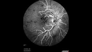 Central Retinal Vein Occlusion [upl. by Rocher]