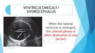 VENTRICULOMEGALYHYDROCEPHALUS A2Z of Ultrasound [upl. by Faubert]