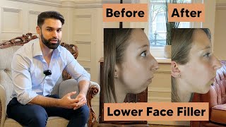 Lower Face Transformation using Filler [upl. by Dadivitan]